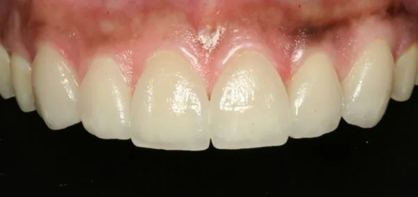 After Dental Veneers photo: Patient 2 with white, even upper teeth