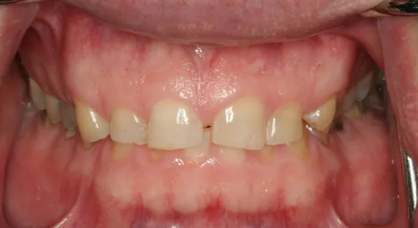 Before full mouth reconstruction photo: Front view of GURD patient with extremely worn and gappy teeth