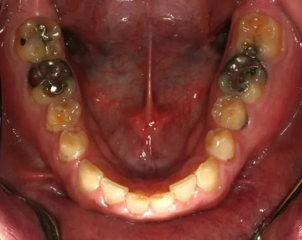 Before Full Mouth Reconstruction inside lower mouth photo: Patient's extremely worn, discolored teeth and silver fillings