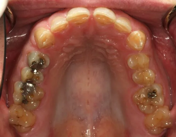 Before Full Mouth Reconstruction inside upper mouth photo: Patient's extremely worn teeth and silver fillings