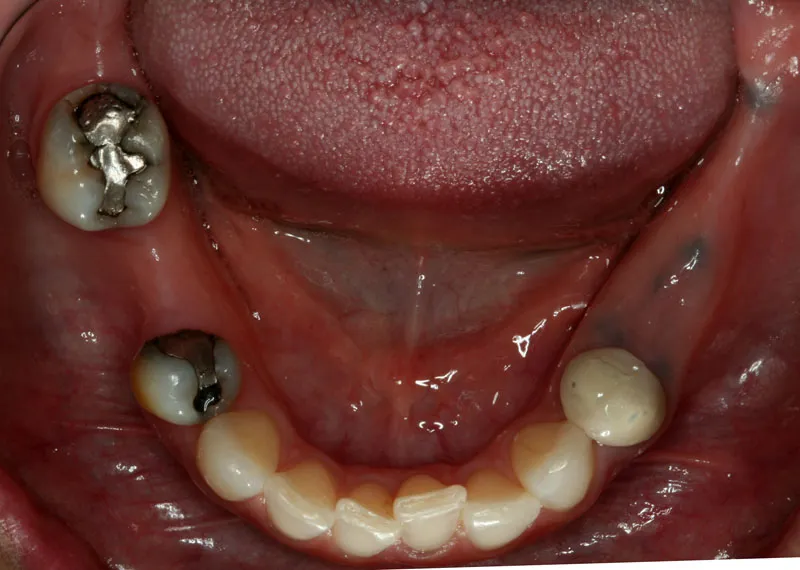 Before Partial Dentures photo: Patient mouth with silver fillings and missing lower back teeth