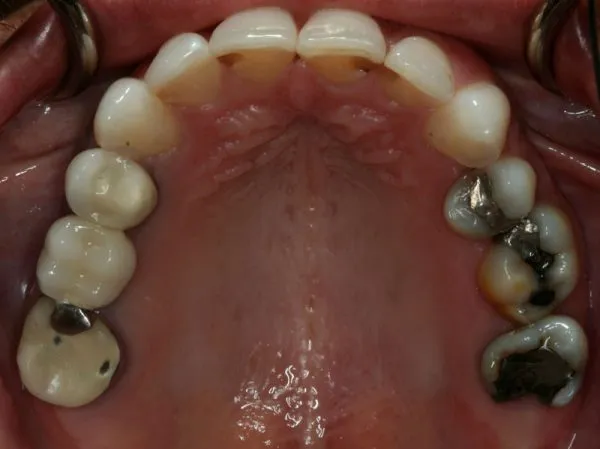 Before Partial Denture photo: Roof of Patient's mouth, showing decayed molars and fillings