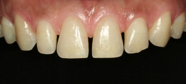 Before dental veneers photo: Patient 2 with worn, gappy upper teeth