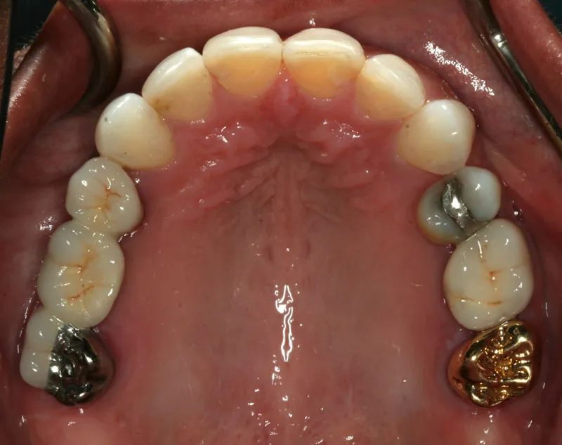 After photo: Patient with dental crowns to restore missing upper teeth