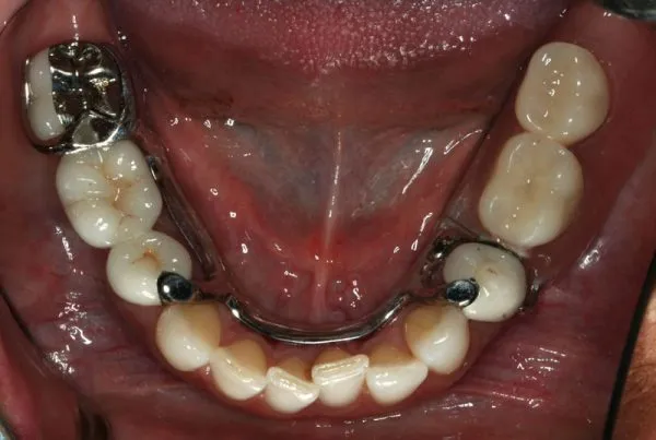 After photo: Patient with 3-Unit Bridge and Partial Denture to restore missing lower back teeth