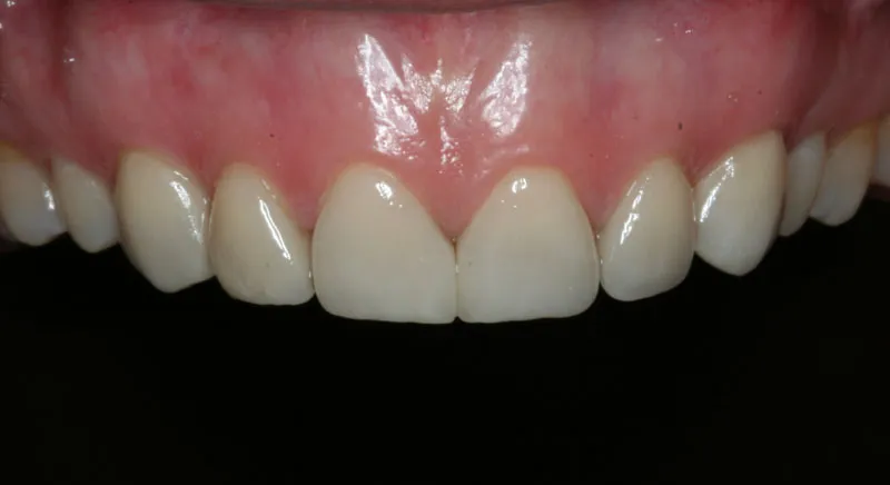 After Porcelain Veneers photo: Patient 1 with full sized, white upper teeth