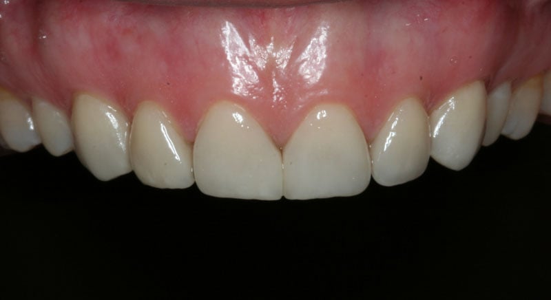 After Porcelain Veneers photo: Patient 1 with full sized, white upper teeth