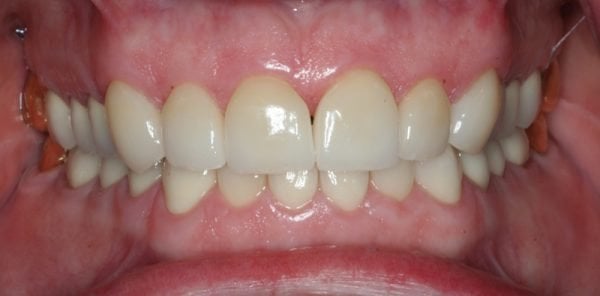 After front view photo of patient with full size, even teeth