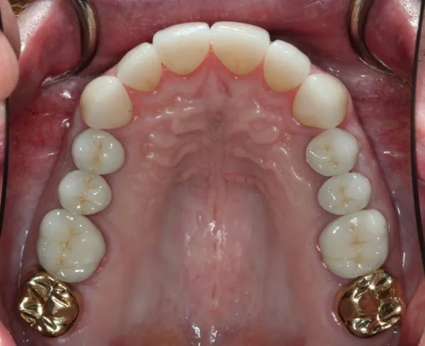 After Full Mouth Reconstruction inside upper mouth photo: Patient's whiter, restored teeth with two gold crown molars