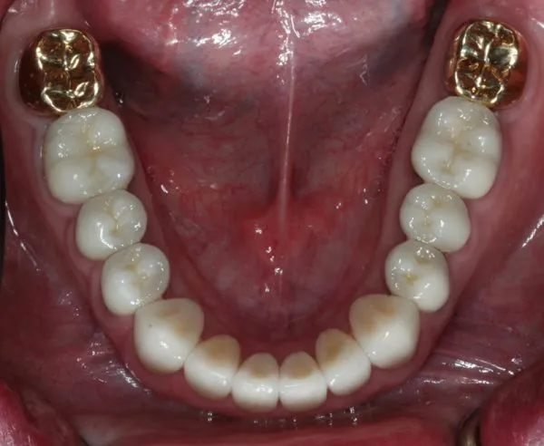 After Full Mouth Reconstruction inside lower mouth photo: Patient's whiter, restored teeth with 2 gold molar crowns