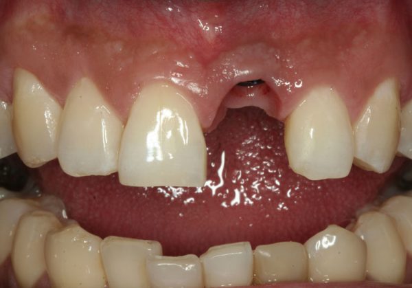Before photo of missing upper tooth with dental implant post