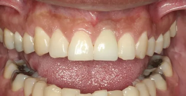 After photo of Patient's top front teeth and replaced missing front tooth