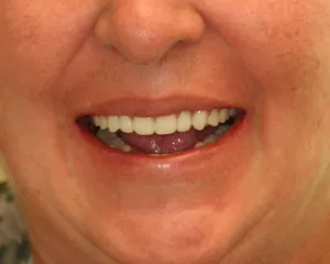 After front facial view of patient wearing their complete dentures