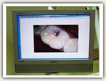 Photo of small intraoral camera technology
