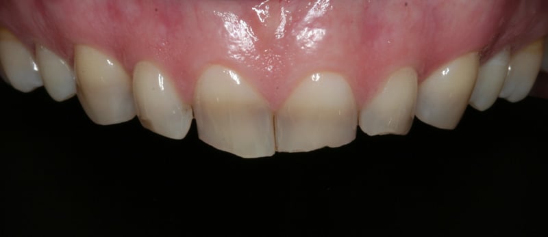 Before Veneers photo: Patient 1 with chipped, worn & tetracycline-discolored upper teeth