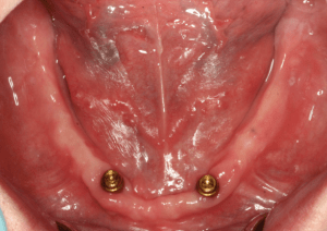 Before Complete Denture photo: Lower jaw, missing all teeth, with 2 dental implants placed.